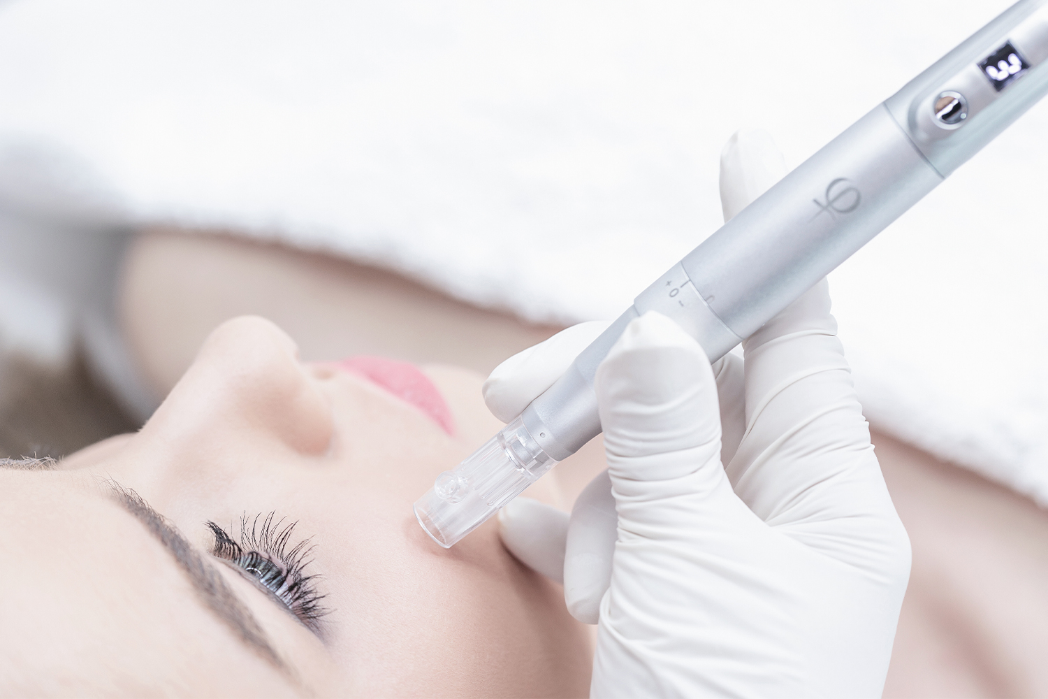 Procédure de microneedling avec un dermapen